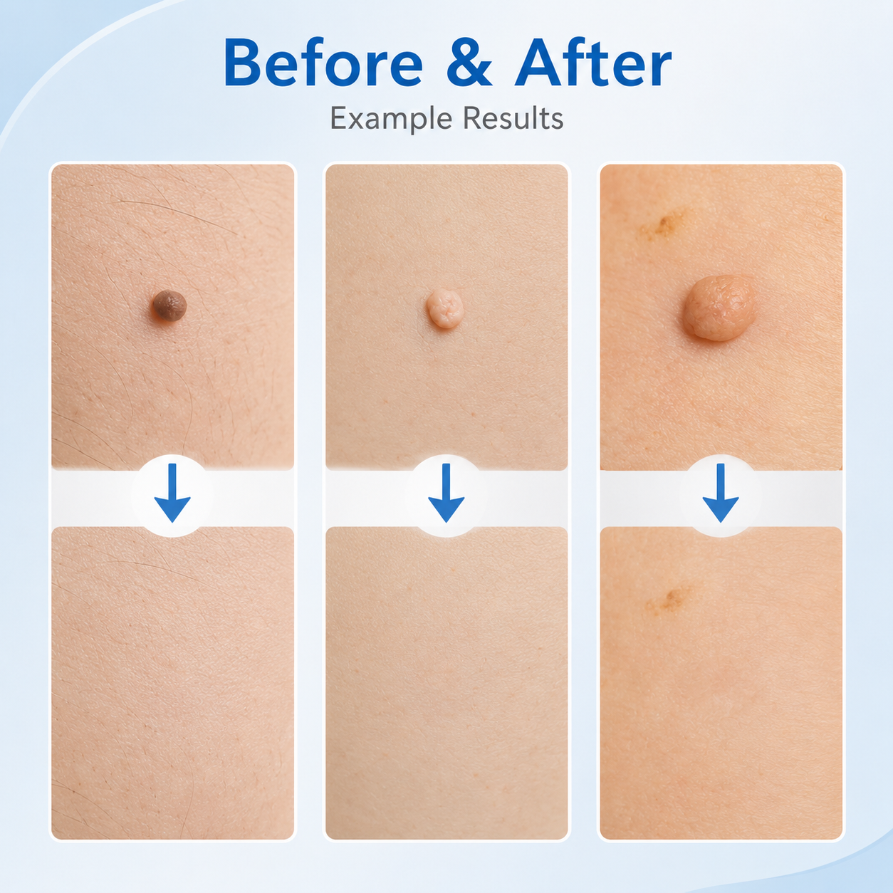 🩹 Skin Tag Removal Kit – 2-in-1 Auto Band Applicator with Dual Size Options for At-Home Use