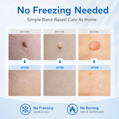 🩹 Skin Tag Removal Kit – 2-in-1 Auto Band Applicator with Dual Size Options for At-Home Use